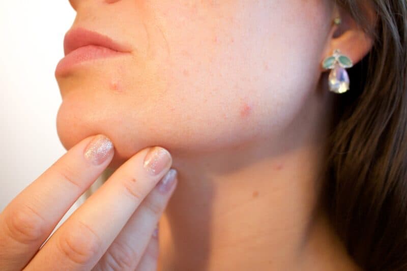  Zits and hormonal breakouts along the jawline and chin can be a common symptom of pregnancy. 